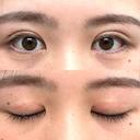 二重切開 つだ美容外科クリニック DAY 103 サムネイル用