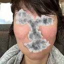 骨削り（エラ） / 骨削り（頬） ボンディ美容整形外科（旧リオン整形外科） DAY 7 サムネイル用