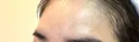 ボトックス（額） TCB東京中央美容外科 岡山院 DAY 8 サムネイル用