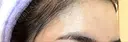 ボトックス（額） TCB東京中央美容外科 岡山院 DAY 8 サムネイル用