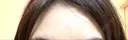 ボトックス（額） TCB東京中央美容外科 岡山院 DAY 9 サムネイル用
