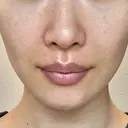 ヒアルロン酸注入（あご） / ヒアルロン酸注入（鼻翼基部） HAAB×DREAM BEAUTY CLINIC 東京本院 DAY 2 サムネイル用