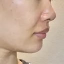 ヒアルロン酸注入（あご） / ヒアルロン酸注入（鼻翼基部） HAAB×DREAM BEAUTY CLINIC 東京本院 DAY 2 サムネイル用
