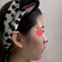 隆鼻術 / 鼻中隔延長（切開） / 鼻翼基部形成（貴族手術） ヴェリテクリニック 銀座院 DAY 70 サムネイル用