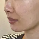 ヒアルロン酸注入（あご） / ヒアルロン酸注入（鼻翼基部） HAAB×DREAM BEAUTY CLINIC 東京本院 DAY 3 サムネイル用