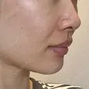 ヒアルロン酸注入（あご） / ヒアルロン酸注入（鼻翼基部） HAAB×DREAM BEAUTY CLINIC 東京本院 DAY 3 サムネイル用