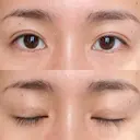 二重埋没 あじまビューティークリニック DAY 33 サムネイル用