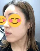 ハイフ（顔） 東京美容外科 熊本院 DAY 11 サムネイル用