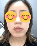 ハイフ（顔） 東京美容外科 熊本院 DAY 11 サムネイル用