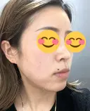 ハイフ（顔） 東京美容外科 熊本院 DAY 11 サムネイル用