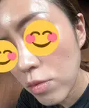 ハイフ（顔） 東京美容外科 熊本院 DAY 10 サムネイル用