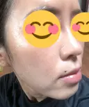 ハイフ（顔） 東京美容外科 熊本院 DAY 10 サムネイル用