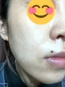 ハイフ（顔） 東京美容外科 熊本院 DAY 12 サムネイル用