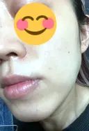 ハイフ（顔） 東京美容外科 熊本院 DAY 12 サムネイル用