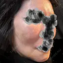 骨削り（エラ） / 骨削り（頬） ボンディ美容整形外科（旧リオン整形外科） DAY 15 サムネイル用