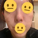 脂肪溶解注射（顔） / シワ取りボトックス / ボトックス（眉間） / ボトックス（目尻） TCB東京中央美容外科 梅田茶屋町院 DAY 4 サムネイル用