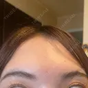 脂肪溶解注射（顔） / シワ取りボトックス / ボトックス（眉間） / ボトックス（目尻） TCB東京中央美容外科 梅田茶屋町院 DAY 4 サムネイル用