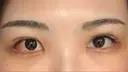 目尻切開 / 目尻靭帯移動 S.T styleクリニック DAY 8 サムネイル用