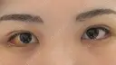 目尻切開 / 目尻靭帯移動 S.T styleクリニック DAY 10 サムネイル用