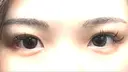 目尻切開 / 目尻靭帯移動 S.T styleクリニック AFTER サムネイル用