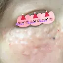 リジュラン 東京ココセランクリニック AFTER サムネイル用