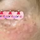 リジュラン 東京ココセランクリニック DAY 0 サムネイル用