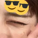 脂肪溶解注射（顔） / シワ取りボトックス / ボトックス（眉間） / ボトックス（目尻） TCB東京中央美容外科 梅田茶屋町院 DAY 5 サムネイル用