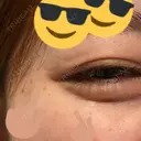 脂肪溶解注射（顔） / シワ取りボトックス / ボトックス（眉間） / ボトックス（目尻） TCB東京中央美容外科 梅田茶屋町院 DAY 5 サムネイル用