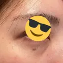 脂肪溶解注射（顔） / シワ取りボトックス / ボトックス（眉間） / ボトックス（目尻） TCB東京中央美容外科 梅田茶屋町院 DAY 5 サムネイル用