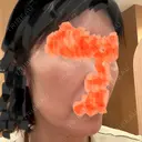 骨削り（エラ） / 骨削り（頬） ボンディ美容整形外科（旧リオン整形外科） DAY 15 サムネイル用