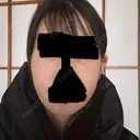 クマ治療 / 脂肪注入（肌） / 脂肪注入（目の下） EMMO FACE CLINIC 大宮院 AFTER サムネイル用