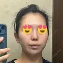 鼻尖形成（切開） / 小鼻縮小（切開） / 脂肪吸引（顔） / 軟骨移植 / 骨切幅寄せ / 鼻尖縮小 / 鼻柱挙上 銀座マイアミ美容外科 DAY 34 サムネイル用