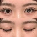 二重切開 つだ美容外科クリニック DAY 109 サムネイル用