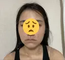 糸リフト / 脂肪吸引注射（顔） / 脂肪注入（輪郭） イテウォンビューティークリニック 名古屋栄院 DAY 1 サムネイル用