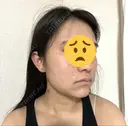 糸リフト / 脂肪吸引注射（顔） / 脂肪注入（輪郭） イテウォンビューティークリニック 名古屋栄院 DAY 1 サムネイル用