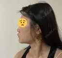 糸リフト / 脂肪吸引注射（顔） / 脂肪注入（輪郭） イテウォンビューティークリニック 名古屋栄院 DAY 1 サムネイル用