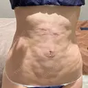 脂肪吸引（二の腕） / 脂肪冷却（お腹） Mods Clinic（モッズクリニック） 東京院 DAY 112 サムネイル用