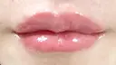 ヒアルロン酸注入（唇） / ボトックス（口角） ルラ美容クリニック 渋谷本院 AFTER サムネイル用
