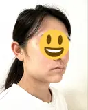 糸リフト / 脂肪吸引注射（顔） / 脂肪注入（輪郭） イテウォンビューティークリニック 名古屋栄院 DAY 3 サムネイル用