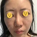 その他（肌） / 美肌レーザー 湘南美容クリニック 静岡院 AFTER サムネイル用