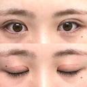二重切開 つだ美容外科クリニック DAY 111 サムネイル用