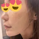 糸リフト / 脂肪吸引（顔） / ボトックス（エラ・小顔） / ヒアルロン酸注入（頬） Tokyo Tensei Clinic 新宿院 DAY 54 サムネイル用