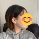 骨削り（エラ） / 脂肪吸引（顔） id（アイディ）美容外科 DAY 10 サムネイル用