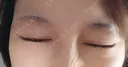 ボトックス（眉間） 湘南美容クリニック 本厚木院 DAY 9 サムネイル用
