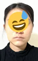 糸リフト / 脂肪吸引注射（顔） / 脂肪注入（輪郭） イテウォンビューティークリニック 名古屋栄院 AFTER サムネイル用