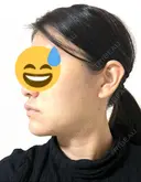 糸リフト / 脂肪吸引注射（顔） / 脂肪注入（輪郭） イテウォンビューティークリニック 名古屋栄院 DAY 4 サムネイル用