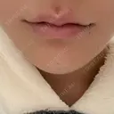 ボトックス（あご） / ヒアルロン酸注入（唇） / ボトックス（口角） ルラ美容クリニック 大阪本院 DAY 0 サムネイル用