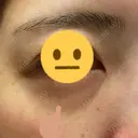 脂肪溶解注射（顔） / シワ取りボトックス / ボトックス（眉間） / ボトックス（目尻） TCB東京中央美容外科 梅田茶屋町院 AFTER サムネイル用