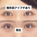 二重切開 つだ美容外科クリニック DAY 112 サムネイル用