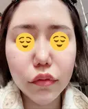 ボトックス（エラ・小顔） / ヒアルロン酸注入（頬） 高崎TAクリニック AFTER サムネイル用